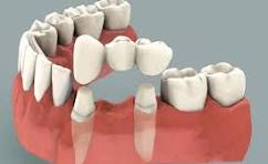 Dental Bridge and Crowns